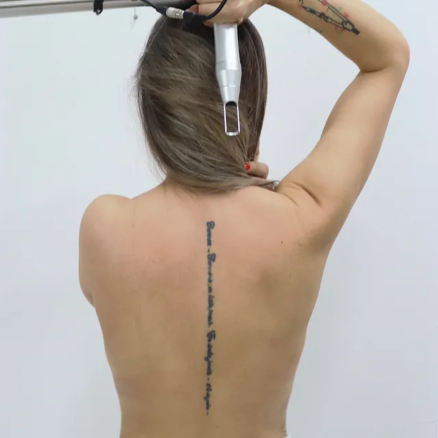 eliminando tatuaje