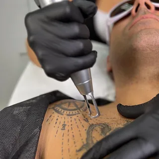 ELIMINACIÓN TATUAJES 