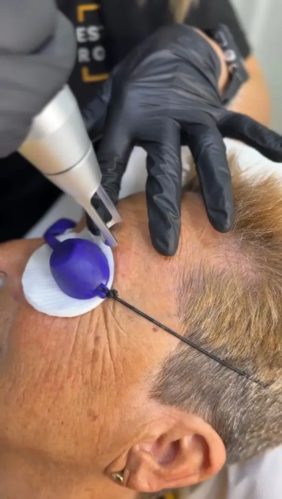 eliminación de micropigmentación con láser