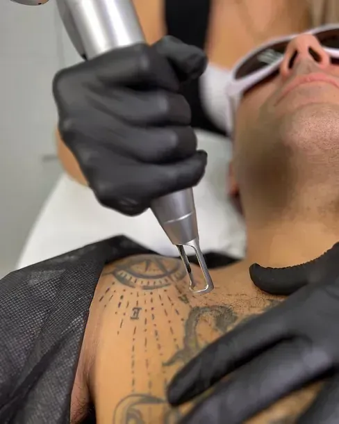 eliminación de tatuajes con láser